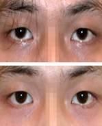 黑眼圈去除效果對比圖2