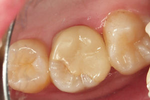 牙髓變性 牙髓變性