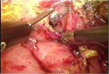 急性結腸假性梗阻綜合徵 急性結腸假性梗阻綜合徵