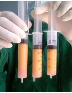 吸脂手術 吸脂手術