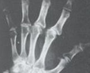 卡斯欽-貝克病 卡斯欽-貝克病