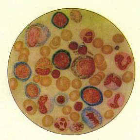 小兒營養性巨幼紅細胞性貧血