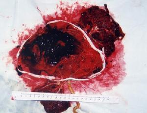 （圖）胎盤部位滋養細胞腫瘤