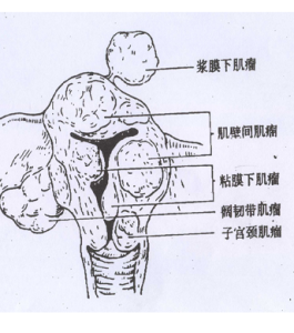 子宮平滑肌瘤