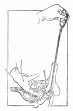 尿道導管插入術