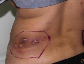 蕈樣肉芽腫瘤 蕈樣肉芽腫瘤