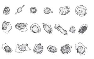 小兒傳染性單核細胞增多症