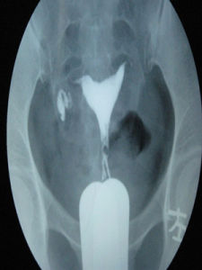 輸卵管造影 輸卵管造影