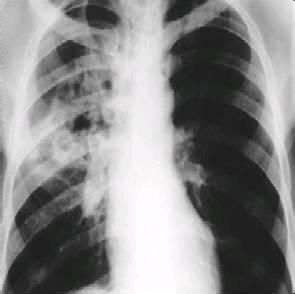 肺結核