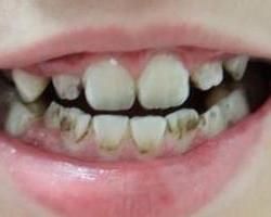 牙根發黑 牙根發黑