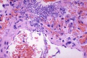 口腔念珠菌感染 口腔念珠菌感染