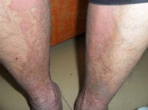 對稱性進行性紅斑角化症 對稱性進行性紅斑角化症