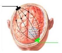 外傷性癲癇 外傷性癲癇