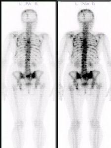 骨掃描 骨掃描