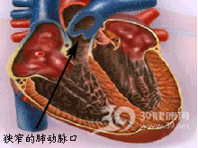 肺動脈口狹窄