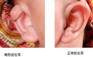 隱耳整形 隱耳整形