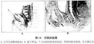 先天性肛門直腸畸形