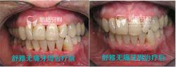 舒雅無痛牙周治療案例