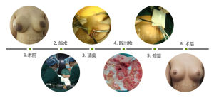 內鏡奧美定取出乳房修復