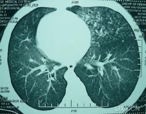 kartagener性綜合徵 kartagener性綜合徵