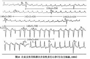 左束支傳導阻滯