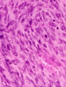 纖維肉瘤 纖維肉瘤