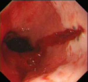 Mallory-Weiss綜合徵 Mallory-Weiss綜合徵