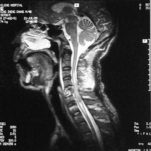鎖骨下動脈盜血綜合徵