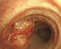 咽部乳頭狀瘤 咽部乳頭狀瘤