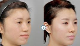 凸嘴手術 凸嘴手術