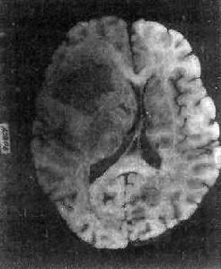 星形膠質細胞瘤細胞 星形膠質細胞瘤細胞