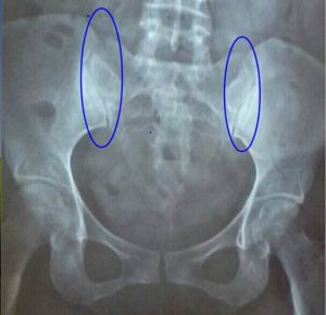 關節間隙 關節間隙