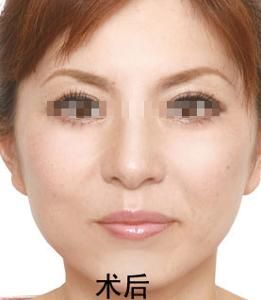 鼻唇溝變淺 鼻唇溝變淺