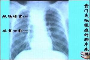 賁門失弛緩症 賁門失弛緩症