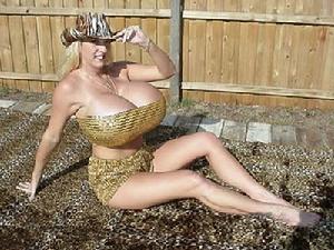 成人型女性乳房肥大症 成人型女性乳房肥大症