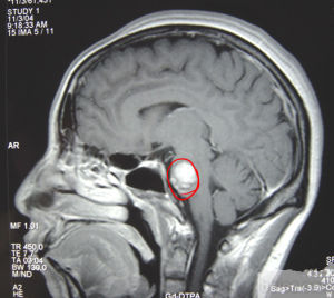 橋腦出血 橋腦出血