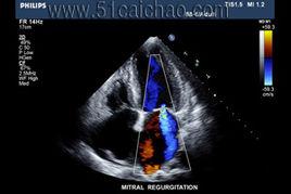 心臟彩色都卜勒 心臟彩色都卜勒