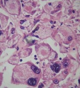 腺泡狀軟組織肉瘤 腺泡狀軟組織肉瘤