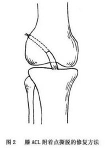十字韌帶損傷