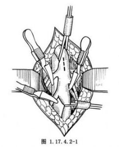 動脈切開術 動脈切開術