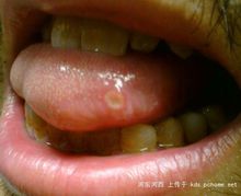 口腔潰瘍