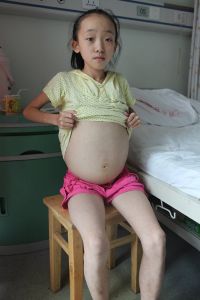 布加氏綜合症 布加氏綜合症