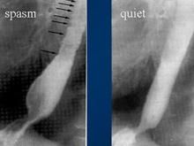 瀰漫性食管痙攣 瀰漫性食管痙攣