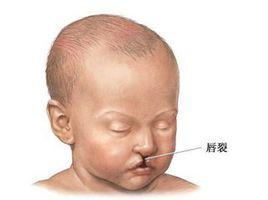 孕婦常豪飲胎兒易患“兔唇”