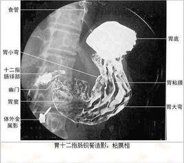 鋇餐透視 鋇餐透視