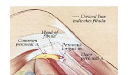 腓總神經卡壓症