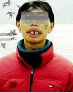 前牙反牙合 前牙反牙合