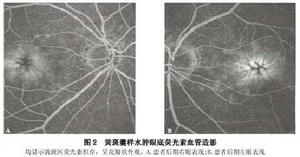 黃斑囊樣水腫