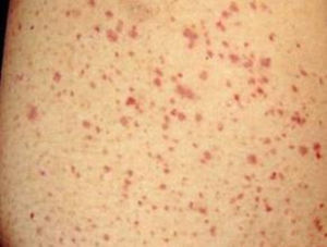 慢性血小板減少性紫癜 慢性血小板減少性紫癜