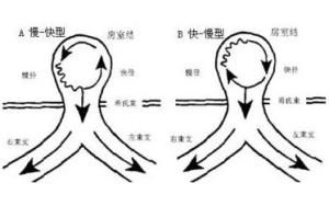 房室結折返性心動過速 房室結折返性心動過速